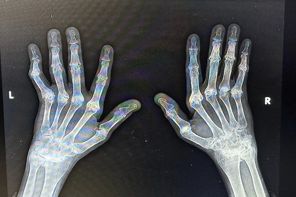 Arthritis In Hands, Starring - My Own Hands