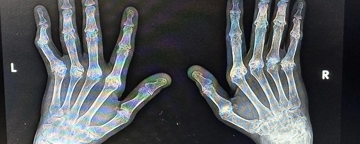 Arthritis In Hands, Starring - My Own Hands
