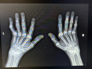 Arthritis In Hands, Starring - My Own Hands - Reclaim Labs