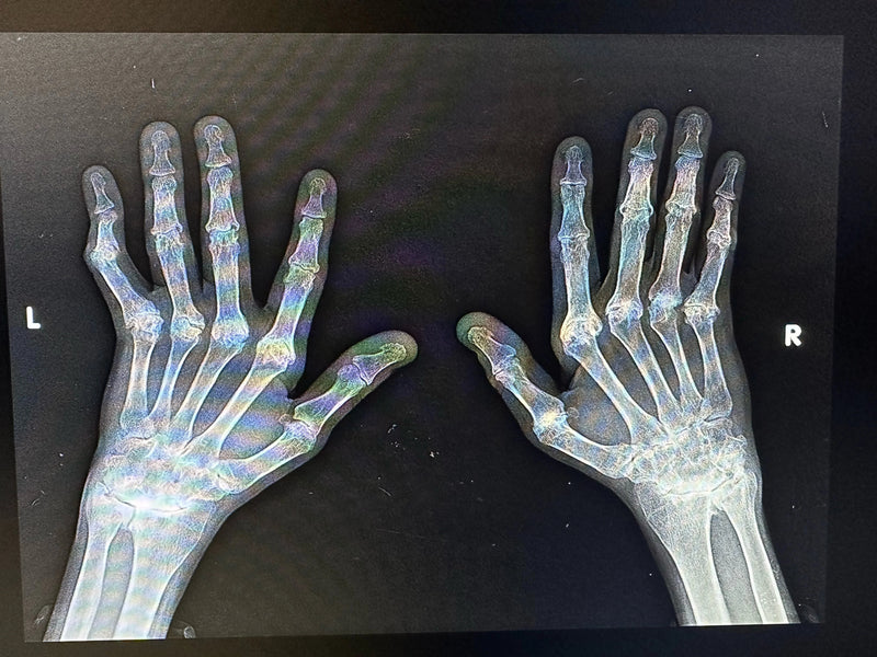 Arthritis In Hands, Starring - My Own Hands