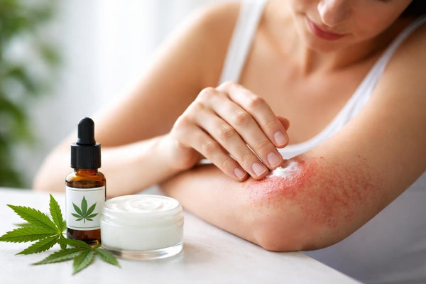 CBD for Eczema Inflammation: Relief & Treatment Guide
