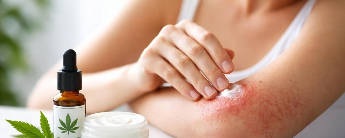 CBD for Eczema Inflammation: Relief & Treatment Guide