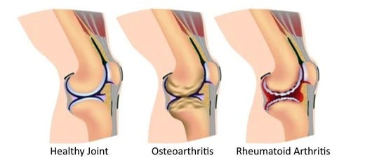 Rheumatoid Arthritis vs Osteoarthritis