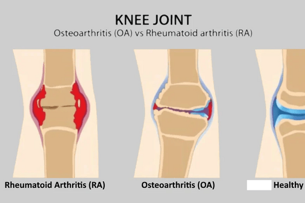 Osteoarthritis vs Rheumatoid Arthritis: Key Differences