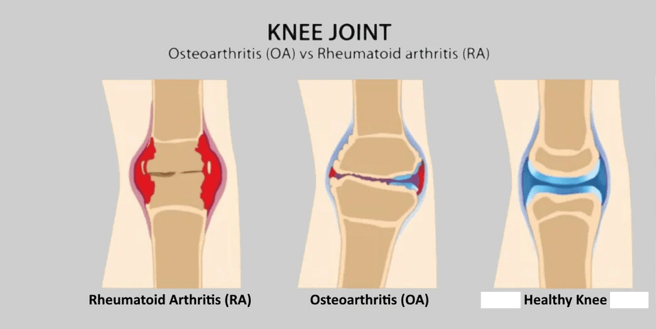 Osteoarthritis vs Rheumatoid Arthritis: Key Differences