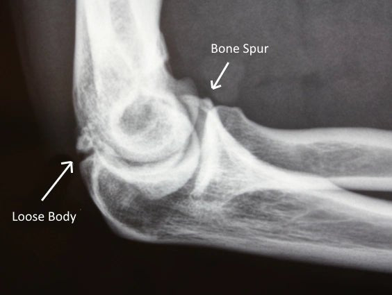 Treating Bone Spurs Naturally with CBD Products